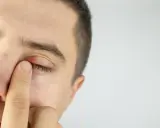 Un homme touche son œil, dont les paupières rouges montrent un orgelet.