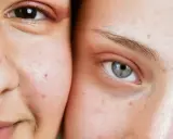 Gros plan sur deux visages, montrant des imperfections cutanées, un bouton stress visible sur la joue de l'une d'elles.