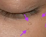 Gros plan sur la peau près de l'œil, montrant plusieurs petits points blancs, des grains de milium percer, indiqués par des flèches violettes.