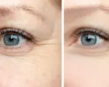 Comparaison avant/après : la peau déshydratée montre des rides marquées autour de l'œil, tandis que la peau hydratée apparaît lisse et repulpée.