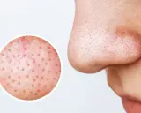 Gros plan sur le nez montrant des filaments sébacés dans les pores. Une loupe révèle la texture de la peau, suggérant des remèdes maison pour les imperfections.