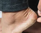 Gros plan sur un talon sec et craquelé, signe de xérose pied. La peau est rugueuse et des lambeaux se détachent.