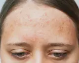 Front de la peau avec des rougeurs et des imperfections, signes d'acné rétentionnelle.