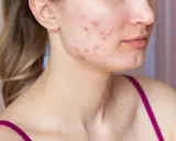 Visage d'une jeune femme montrant des rougeurs et des boutons, signes d'acné inflammatoire.