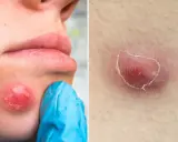 Gros bouton blanc sur la joue, examiné par une main gantée de bleu. Un autre bouton rouge et enflammé sur la peau.