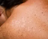 Gros plan sur une épaule et un cou montrant une peau bronzée avec des taches brunes et des zones de peau qui pèle, signe d'un coup de soleil.