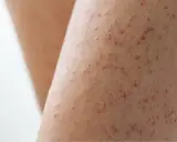 Gros plan sur une peau présentant de petites rougeurs et aspérités, signe d'un excès de kératine peau.
