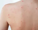Éruption cutanée sur le dos, avec de nombreux petits points rouges, certains semblant être un bouton inflammatoire douloureux.