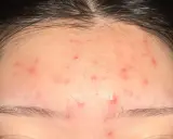 Plusieurs petits boutons rouges parsèment le front, sous la ligne des cheveux.