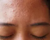 Gros plan sur le front d'une personne avec de nombreux petits boutons blancs, signe d'une peau à imperfections.