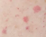 Gros plan sur une peau présentant des pétéchies et des signes de vieillissement cutané, avec des taches rouges et des irrégularités de texture.