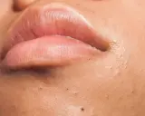 Gros plan sur des lèvres roses et une peau présentant plusieurs points noirs, ces petites imperfections qui peuvent apparaître sur le visage.