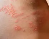 Peau irritée avec un petit bouton cloque qui gratte, formant des grappes rouges et enflammées.