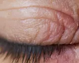 Gros plan sur un œil fermé, montrant des paupières sèches et irritées avec des ridules et des squames.