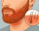 Gros plan sur une barbe rousse avec des pellicules. Un cercle montre une coupe de peau avec des follicules pileux.