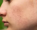 Gros plan sur la joue d'une personne avec de nombreux petits boutons, un bouton de stress qui gratte, et quelques rougeurs.