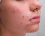 Gros plan sur un visage avec de nombreux boutons blancs et rouges, signe d'une peau à problèmes.