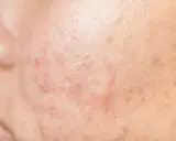 Gros plan sur la peau d'un adulte présentant des rougeurs et des marques, typiques d'un bouton visage adulte.