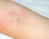 Début d'eczéma sur le bras, avec des plaques rouges et irritées sur la peau claire.