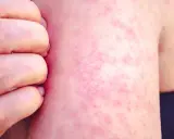 Une peau rougie et irritée, recouverte de petits boutons de chaleur, est grattée par des doigts.