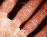 Main sévèrement atteinte par l'eczéma, la peau est rouge, sèche et craquelée, formant un réseau de fines lignes blanches.