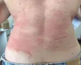 Le dos présente des plaques rouges et irritées, typiques d'un **eczéma peau**. La zone affectée est étendue, allant du cou jusqu'à la taille.