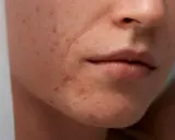 Gros plan sur le visage d'une femme montrant des rougeurs et des imperfections, typiques de l'acné de grossesse.