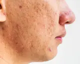 Gros plan sur le visage d'une personne montrant des cicatrices et des rougeurs dues à une acné sévère.