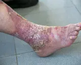 Psoriasis palmo plantaire sévère sur la jambe et le pied, avec peau rouge, squameuse et craquelée.