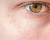 Gros plan sur la peau d'un œil, parsemée de petits points blancs, des grains de milium, qui ressemblent à de minuscules perles incrustées.