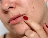 Un doigt avec un ongle rouge touche un petit bouton acné lèvre.