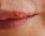 Lèvres rouges et irritées, signe d'un herpes labial que faire pour soulager ?