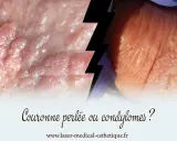 Gros plan sur des papules perlées et des condylomes, deux affections cutanées distinctes.