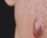 Gros plan sur une peau présentant des pores dilatés et une lésion inflammatoire typique de l'acné conglobata.