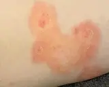 Plaques rouges et squameuses sur la peau, évoquant une mycose fessier adulte.