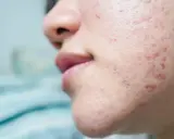 Gros plan sur une peau acnéique, montrant des rougeurs et des imperfections. Ce type d'acné peut être lié à l'effet de la progestérone sur la peau.