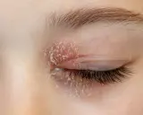 Paupière rouge et irritée avec une plaque rouge sous les yeux allergie, la peau pèle.