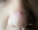 Gros plan sur un nez avec un point noir douloureux et enflammé, entouré de pores visibles.