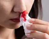 Une personne utilise un mouchoir pour éponger le sang des ailes du nez rouge.