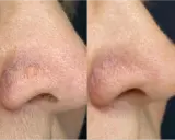 Comparaison avant/après traitement d'une papule fibreuse du nez. La lésion a disparu.
