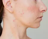 Peau du bas du visage avec des rougeurs et un bouton.