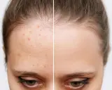 Avant/après : front avec acné et front lisse. L'acide salicylique bienfait pour une peau nette.