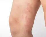Plaques rouges et squameuses sur la jambe, caractéristiques de l'eczéma nummulaire.