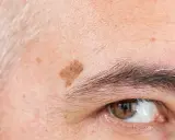 Gros plan sur un œil et un sourcil, avec une tache vieillesse brune sur le front.