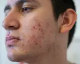 Visage d'un jeune homme avec des rougeurs et des boutons, signes d'acné nodulaire.