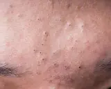 Gros plan sur la peau du front, révélant de minuscules boutons et des pores dilatés, avec des sourcils foncés en bas.
