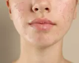 Visage d'une jeune femme avec une peau à tendance acnéique. L'acide salicylique fait ressortir les boutons, révélant une peau en cours de traitement.