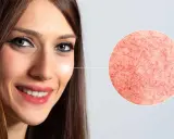 Gros plan sur le visage d'une femme souriante, avec un zoom sur des vaisseaux sanguins dilatés. Pourquoi ce nez rouge ?