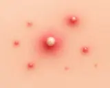 Gros plan sur un type de bouton sur la peau, avec un bouton blanc au centre entouré de rougeurs et de plusieurs petits boutons.