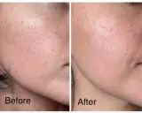 Avant/après : peau avec rougeurs et taches, avant utilisation d'acide azélaïque. Après, la peau est plus lisse, sans danger apparent.
